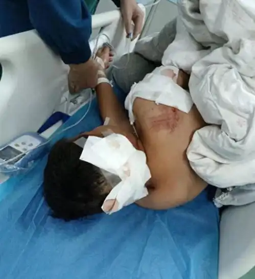 闹大了湖南一10岁小男孩被狗咬伤住院,三天了仍在icu病房救治
