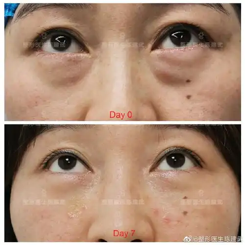 35岁美女先天眼袋不对称,手术后泪沟眼袋改善,卧蚕更明显了
