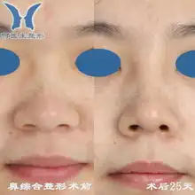 隆鼻综合整形术前术后对比照片110210
