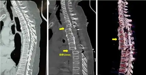 二附院实施中西部首例胸椎后路椎体opll复合物可控前移减压融合手术
