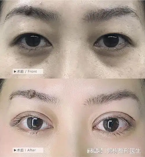 可玉整形郭栋双眼皮科普想做双眼皮哪种术式适合您
