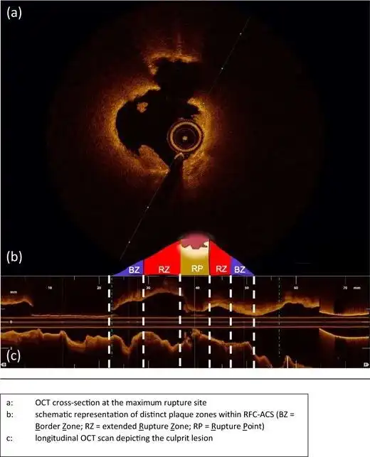 斑块破裂的另一个秘密
