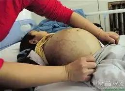 肝炎引起的脾肿大如何治疗呢
