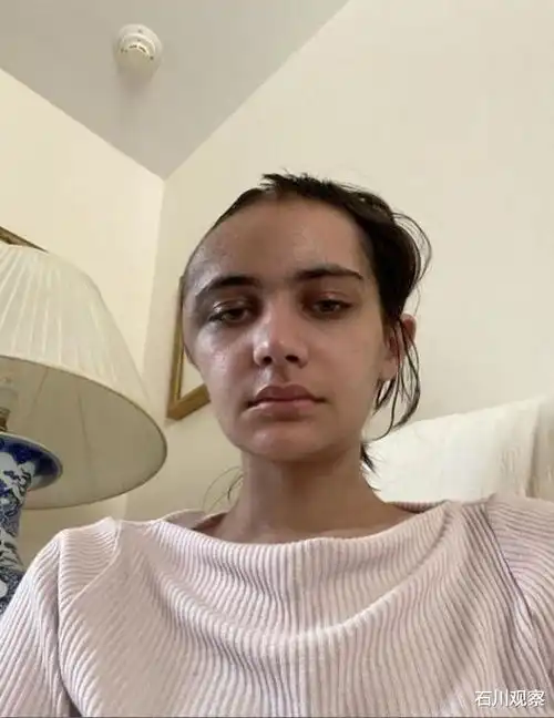 可惜了24岁纽约姑娘被12楼掉下的椅子砸中术后只剩半拉脑袋
