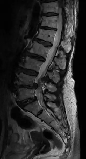 腰椎滑脱,椎管狭窄症后路减压复位椎体间植骨融合术

