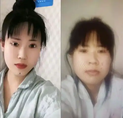 24岁女孩花21万元整形,出院当天跳河自杀,医美机构称无直接关系
