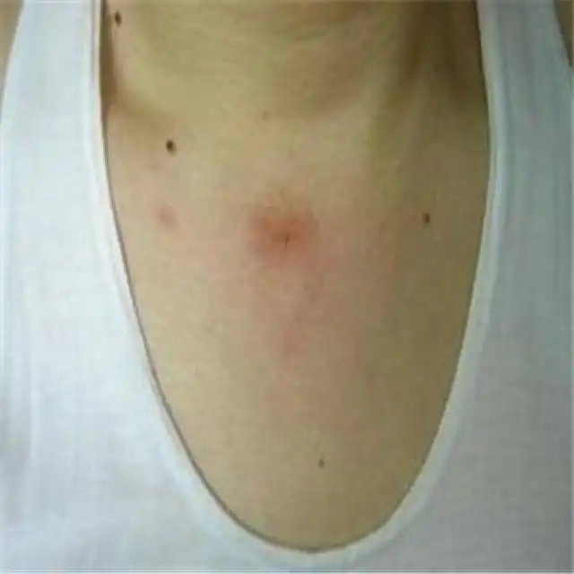 身上有痣没关系,但千万别是这种红痣,大病征兆
