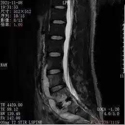 年轻小伙饱受脊柱结核巨大脓肿折磨,市九院专家联手祛痛除因
