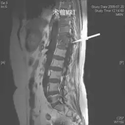 特色医疗脊柱结核

