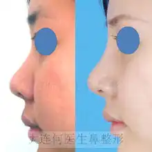 膨体隆鼻,自体软骨修鼻尖鼻子综合整形手术前后对比照片
