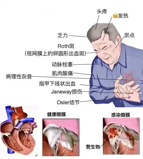 31岁小伙四脏衰竭,普通感冒差点要了命医生提醒有这种症状请尽快就医
