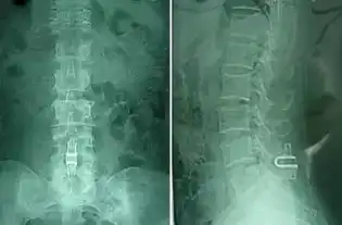 脊柱非融合技术及其展望
