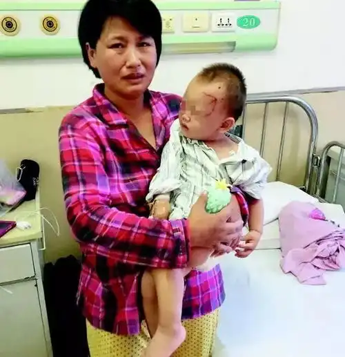 女婴脸部遭凶犬扑咬养狗者谁能证明狗是我家的2牧羊犬发狂主人脸部缝了80针,大家可要小心啊
