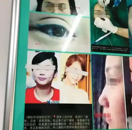 杨紫被整容医院当例子做宣传仅眼睛被贴胶布条
