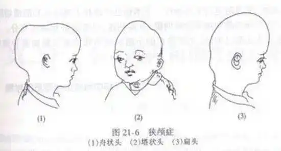 神外科普孩子出现奇怪头型谨防颅缝早闭
