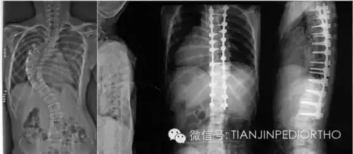 天津医院小儿骨科脊柱畸形矫正策略转载
