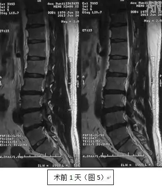 腰椎术后椎管狭窄并姿势性脊柱侧弯
