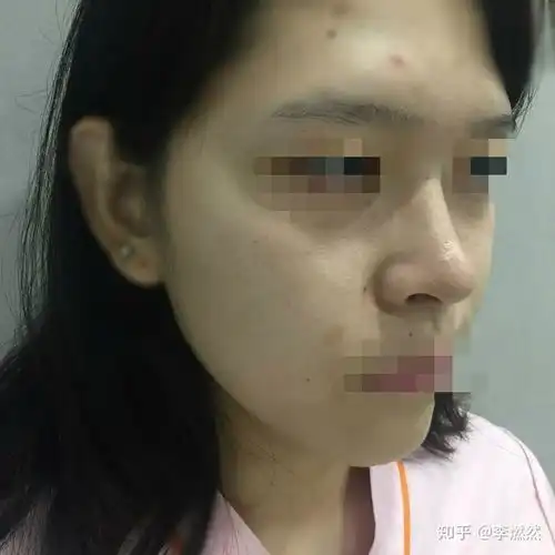 整容失败是种怎样的体验
