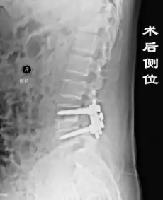 腰椎间盘突出小常识
