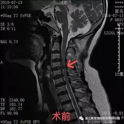新安骨科分院脊柱外科颈椎手术经典案例分享
