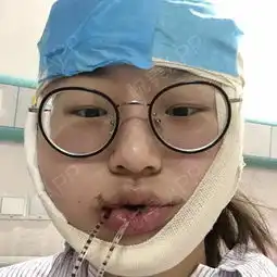 隔了有段时间才来写日记啦,先放一波手术后的照片吧,...磨骨悦美整形
