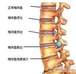 腰椎间盘突出与脱出有关联吗
