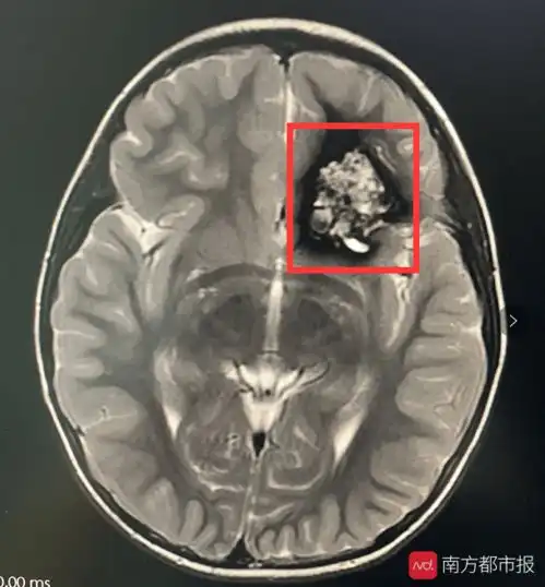 6岁儿童一口气读不了白日依山尽不是贵人语迟是脑肿瘤
