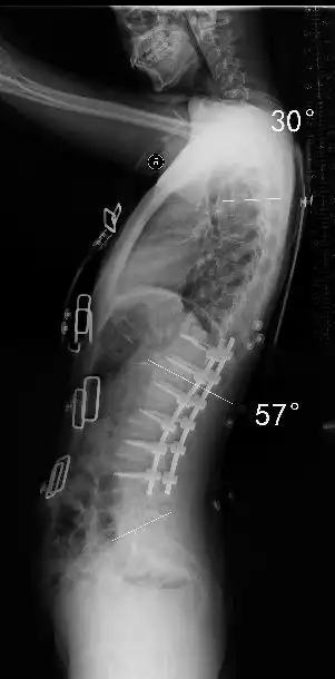 青少年特发性脊柱侧弯的治疗
