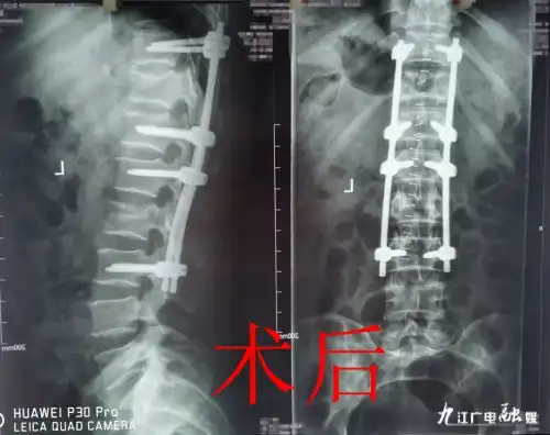 践行脊柱微创理念九江市中医医院完成一例肌间隙入路微创手术
