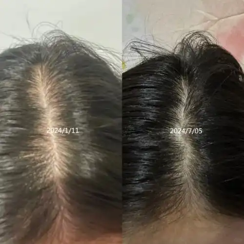 脱发不慌张,来试试最有效果的防脱生发产品
