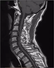 颈椎管狭窄前路还是后路
