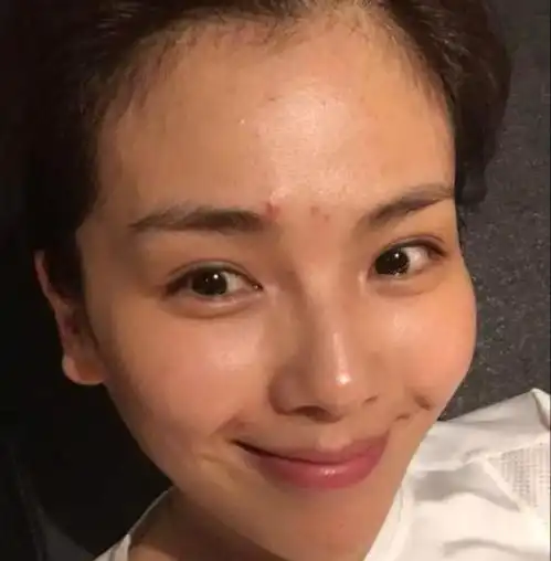 提醒女生脸上痘痘频繁出现,想要改善很简单,只需做好这2点
