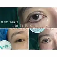 广州双眼皮整形修复价格广州双眼皮整形修复批发广州双眼皮整形修复采购,广州双眼皮整形修复图片产品搜索第1页
