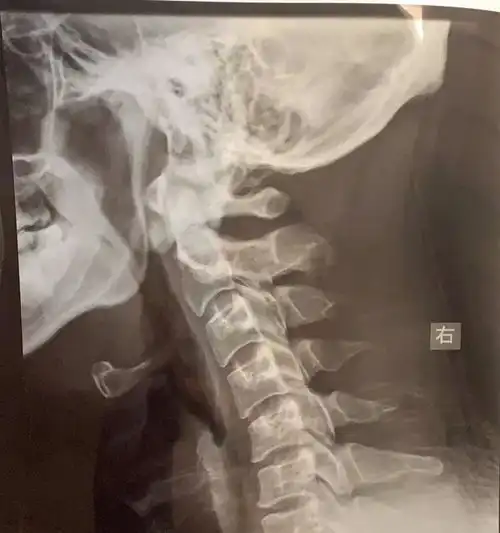 颈部酸痛与眼球和肩胛骨有什么关系
