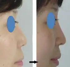 修复隆鼻修鼻头术前术后对比照片
