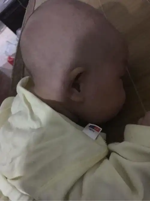 麻烦大家看看我宝宝是舟状头吗这种头型正常吗
