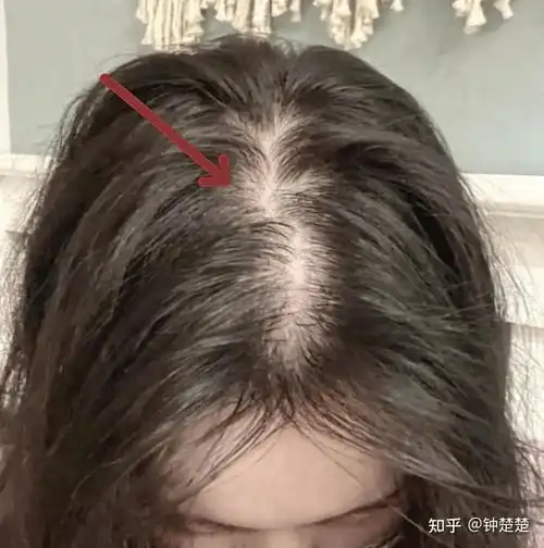 大把脱发头发稀疏发缝宽头顶薄不敢披头发,每次洗完头大把大把的掉,什么防脱洗发水用遍了也没用有什么真正有效的让发量变多的方法
