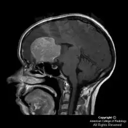 嗅沟脑膜瘤olfactorymeningiomamrict病例图片影像诊断分析
