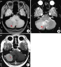 右乙状窦区脑膜瘤纤维型mri病例图片影像诊断影像园
