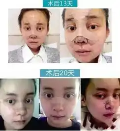 女孩花百万整容成了baby自曝整容日记和心得
