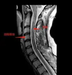 颈椎病脖子长期酸痛,推拿有危险吗
