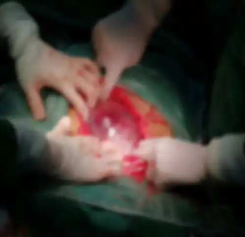 胎盘植入危及母婴生命,有惊无险家属感激万分
