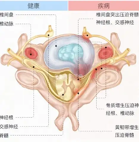 36岁技术大神因颈椎病猝死年轻人,你更应该关注过劳死

