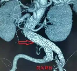 史上最清晰的四大主动脉瘤
